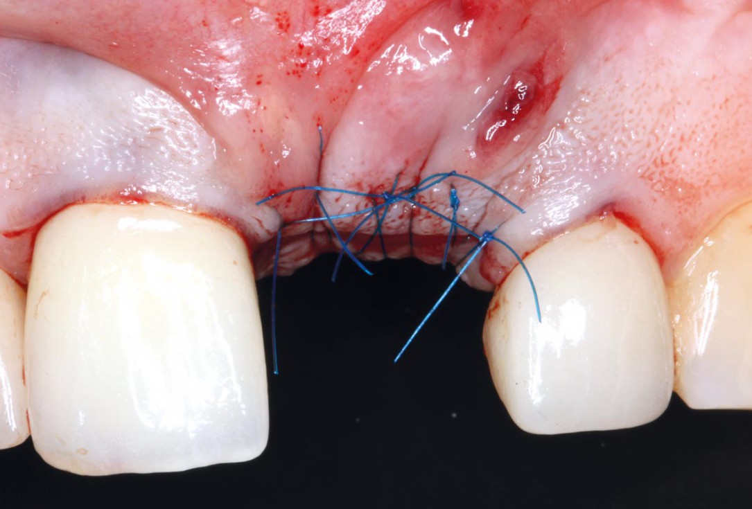 Socket augmentation using mucoderm®, maxgraft® and Straumann® Emdogain® - Dr. A. Puišys