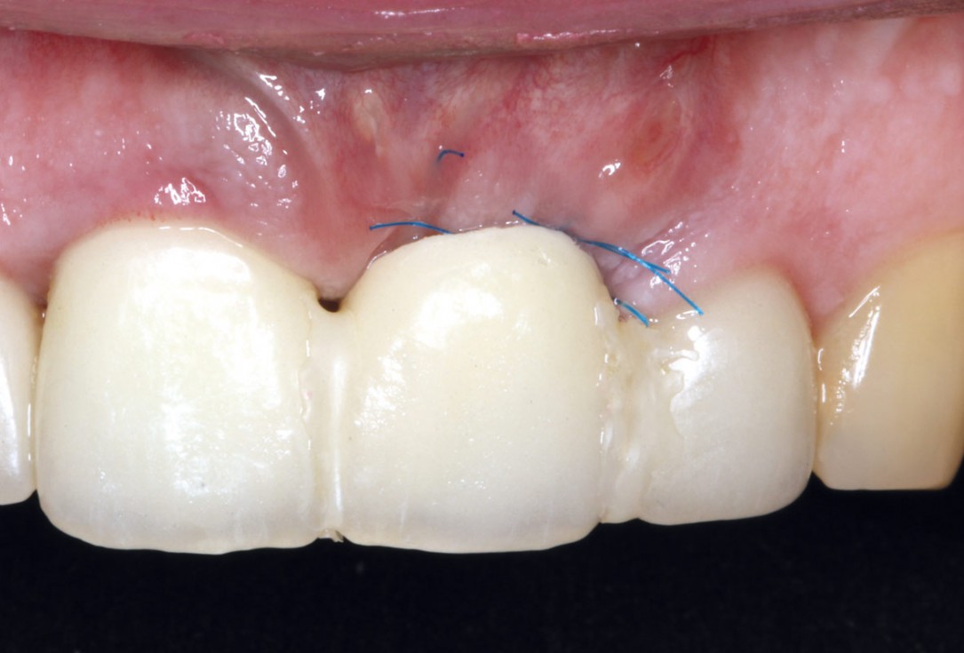 Socket augmentation using mucoderm®, maxgraft® and Straumann® Emdogain® - Dr. A. Puišys