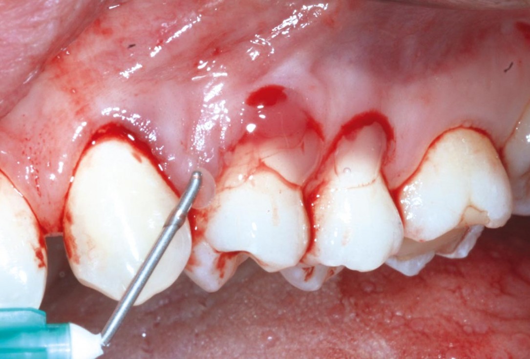 Multiple recession coverage using MCAT in conjunction with mucoderm® and Emdogain® - Dr. D. Rakasevic