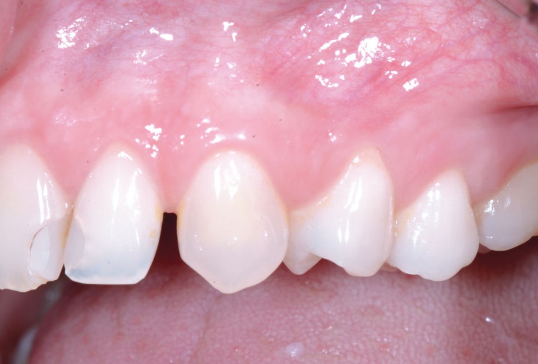 Multiple recession coverage using MCAT in conjunction with mucoderm® and Emdogain® - Dr. D. Rakasevic