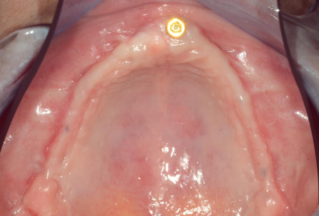 Full arch reconstruction with lack of keratinised tissues-Mólnar/Windisch