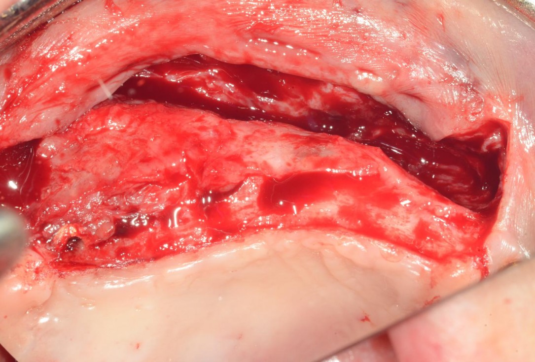Full arch reconstruction with lack of keratinised tissues-Mólnar/Windisch