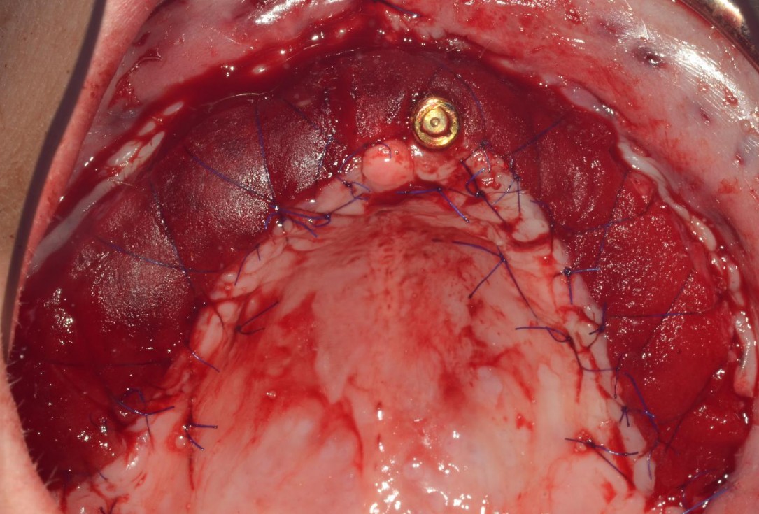Full arch reconstruction with and lack of keratinized tissues-Mólnar/Windisch