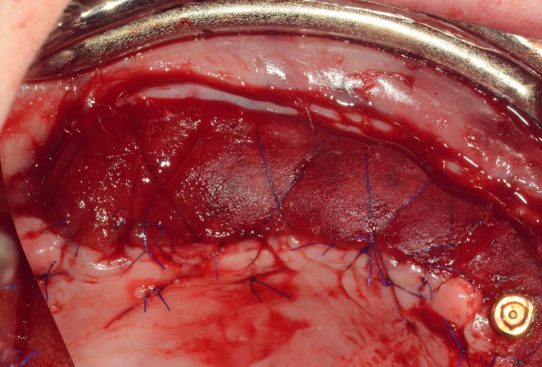 Full arch reconstruction with lack of keratinized tissues-Mólnar/Windisch