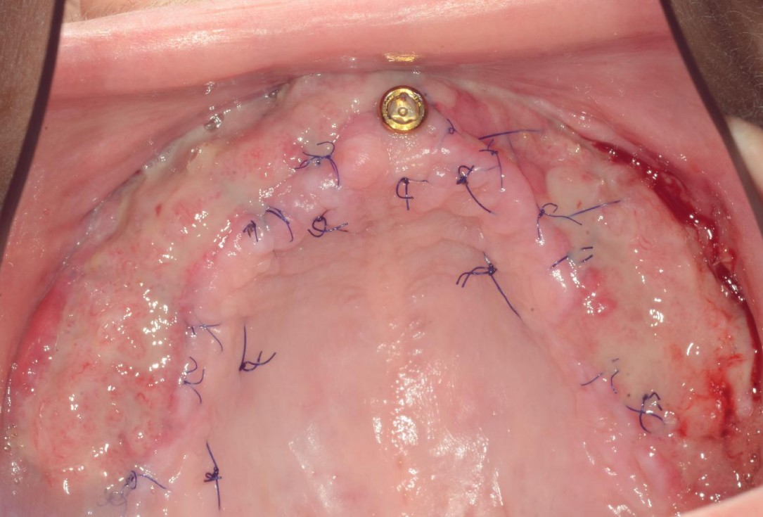 Full arch reconstruction with lack of keratinized tissues-Mólnar/Windisch