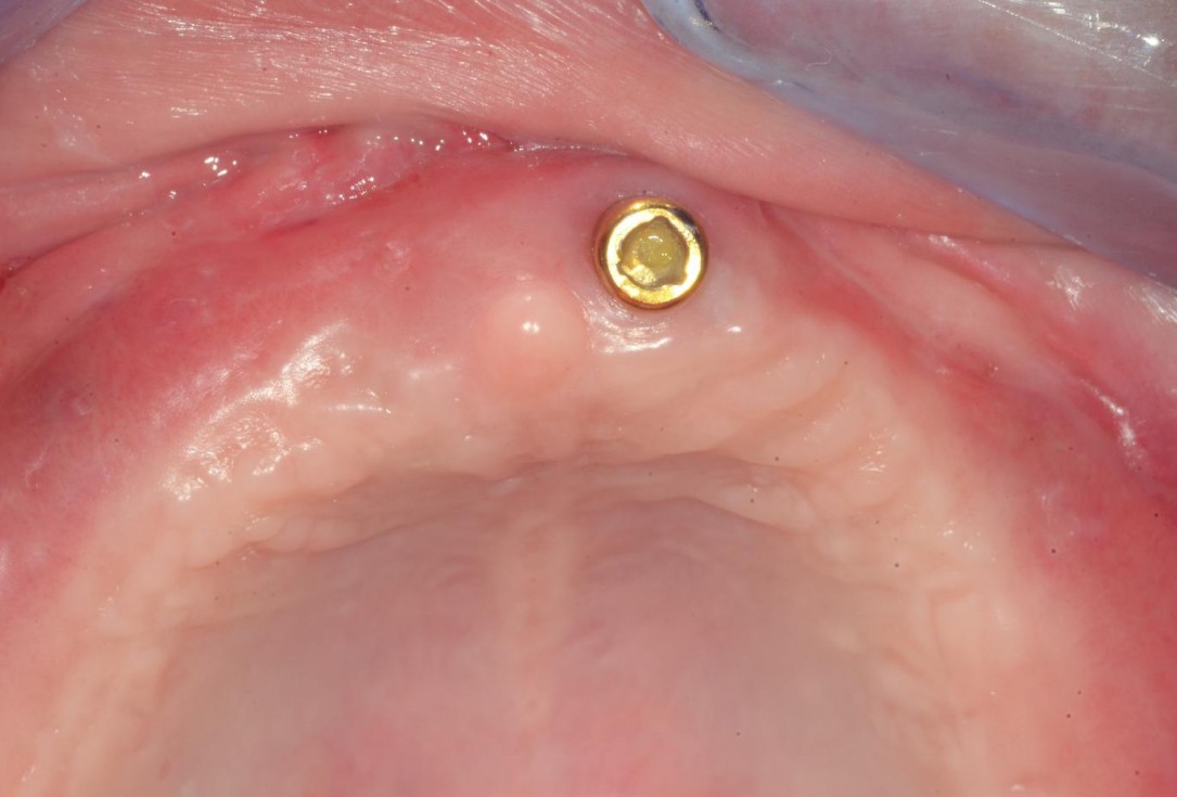 Full arch reconstruction with lack of keratinized tissues-Mólnar/Windisch