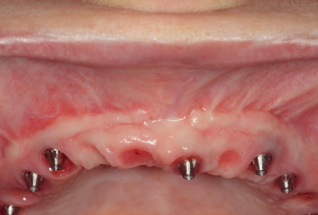 Full arch reconstruction with lack of keratinized tissue-Mólnar/Windisch