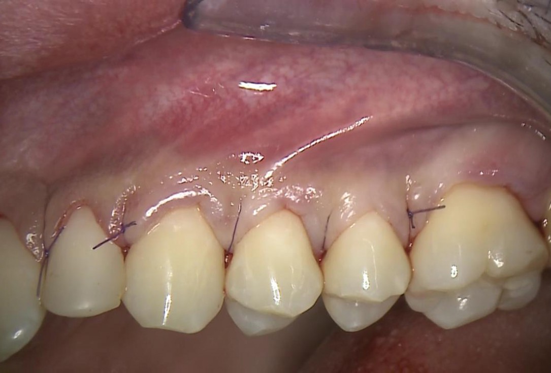 Multiple recession coverage with mucoderm® - Prof. G. Zucchelli & Dr. M. Stefanini