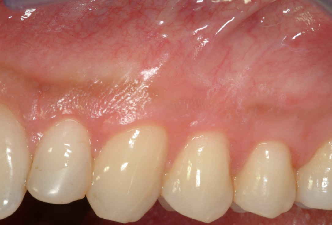 Multiple recession coverage with mucoderm® - Prof. G. Zucchelli & Dr. M. Stefanini
