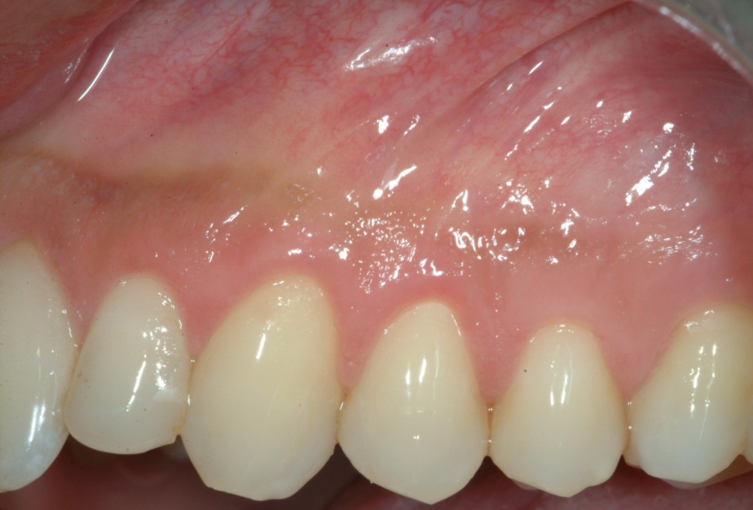 Multiple recession coverage with mucoderm® - Prof. G. Zucchelli & Dr. M. Stefanini