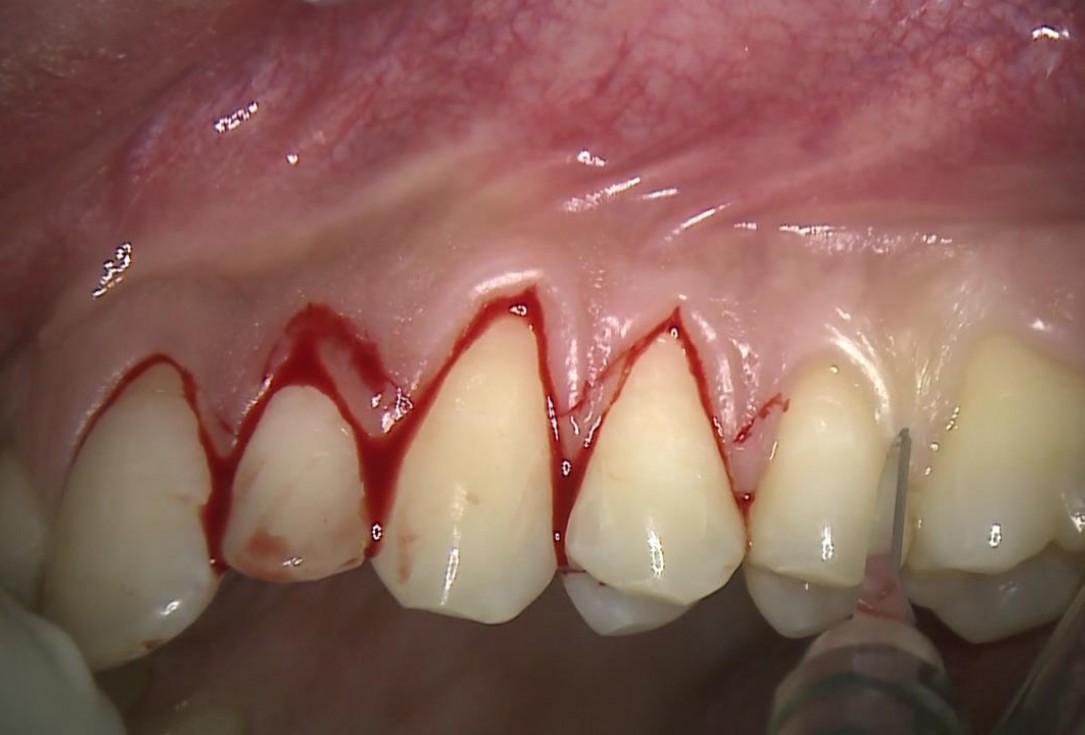 Multiple recession coverage with mucoderm® - Prof. G. Zucchelli & Dr. M. Stefanini