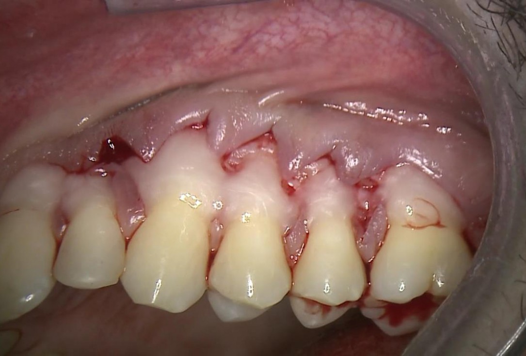 Multiple recession coverage with mucoderm® - Prof. G. Zucchelli & Dr. M. Stefanini