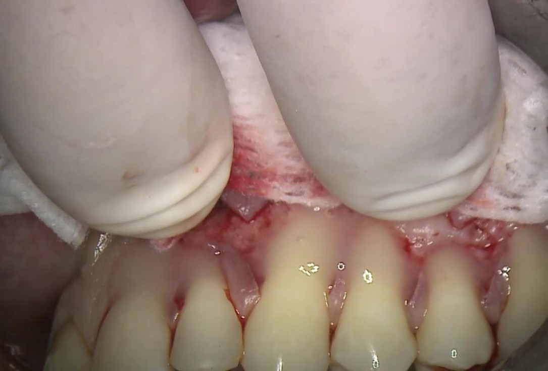 Multiple recession coverage with mucoderm® - Prof. G. Zucchelli & Dr. M. Stefanini