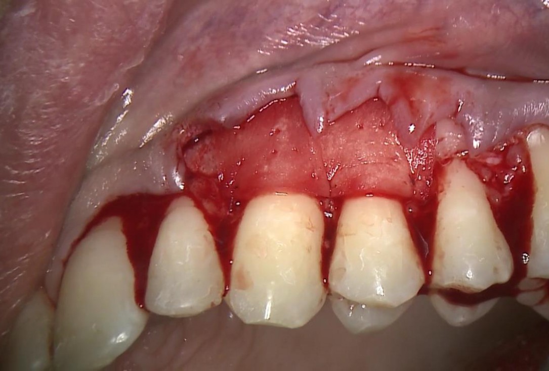 Multiple recession coverage with mucoderm® - Prof. G. Zucchelli & Dr. M. Stefanini