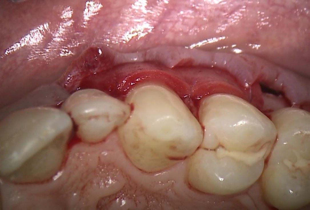 Multiple recession coverage with mucoderm® - Prof. G. Zucchelli & Dr. M. Stefanini