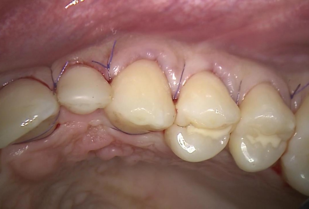 Multiple recession coverage with mucoderm® - Prof. G. Zucchelli & Dr. M. Stefanini