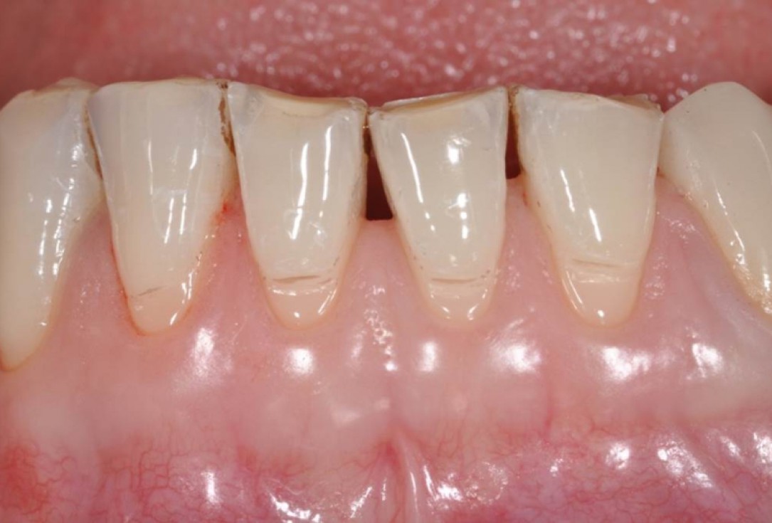 Multiple gingival recessions treated by MCAT in conjunction with mucoderm® - Cosgarea & Sculean