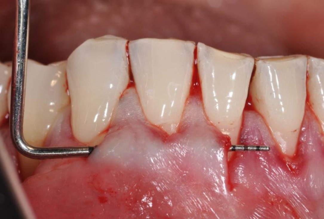 Multiple gingival recessions treated by MCAT in conjunction with mucoderm® - Cosgarea & Sculean