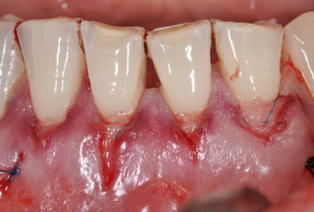 Multiple gingival recessions treated by MCAT in conjunction with mucoderm® - Cosgarea & Sculean