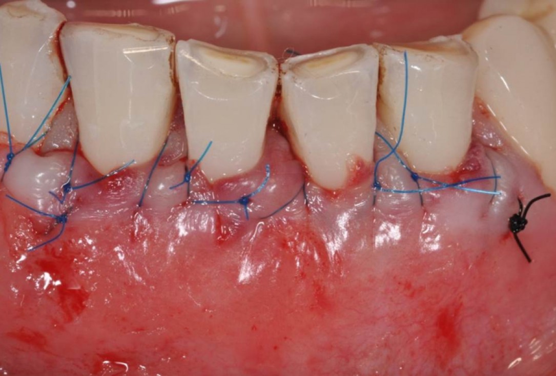 Multiple gingival recessions treated by MCAT in conjunction with mucoderm® - Cosgarea & Sculean