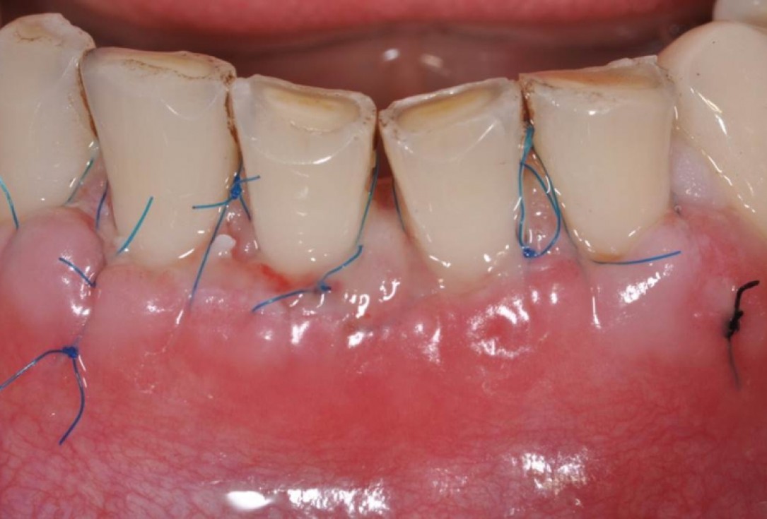 Multiple gingival recessions treated by MCAT in conjunction with mucoderm® - Cosgarea & Sculean