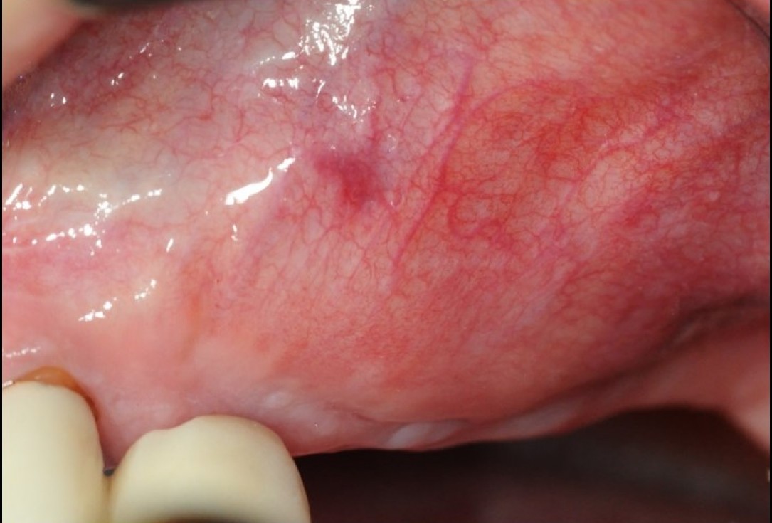 Widening of the peri-implant keratinized mucosa-Horváth