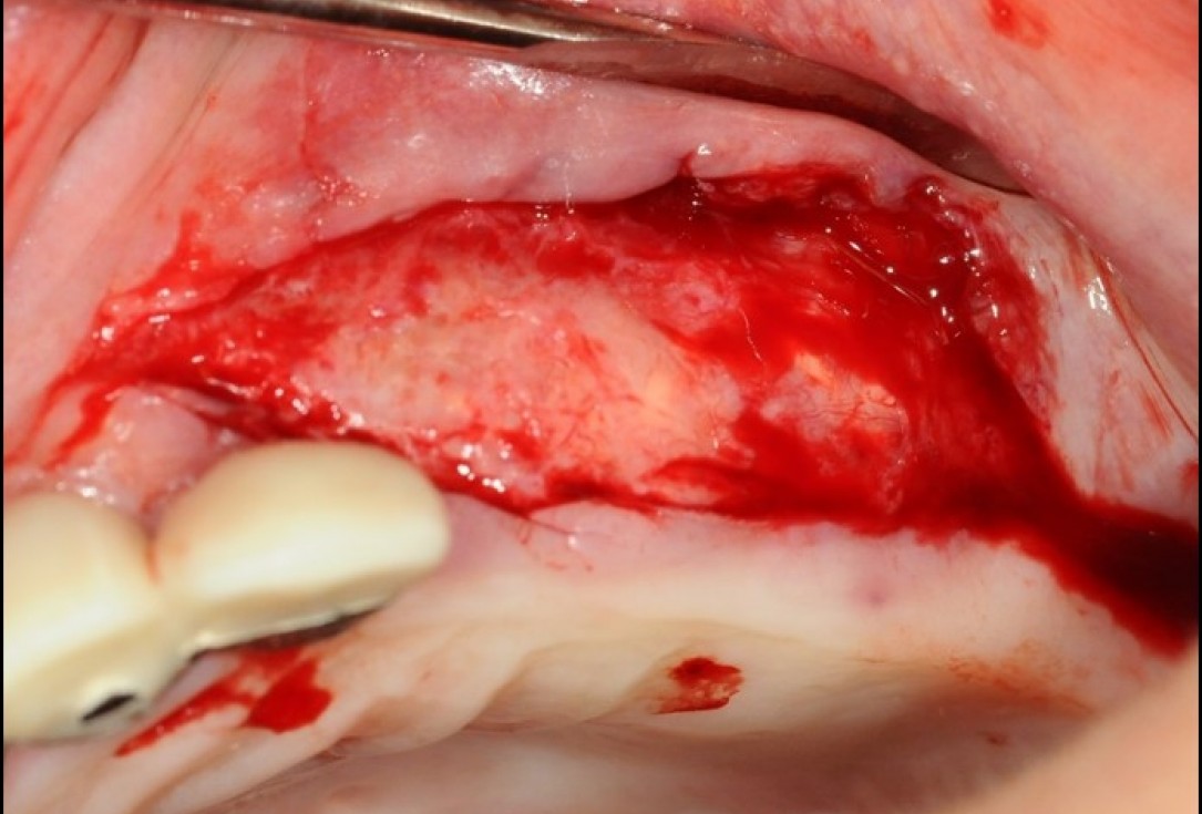 Widening of the peri-implant keratinized mucosa-Horváth