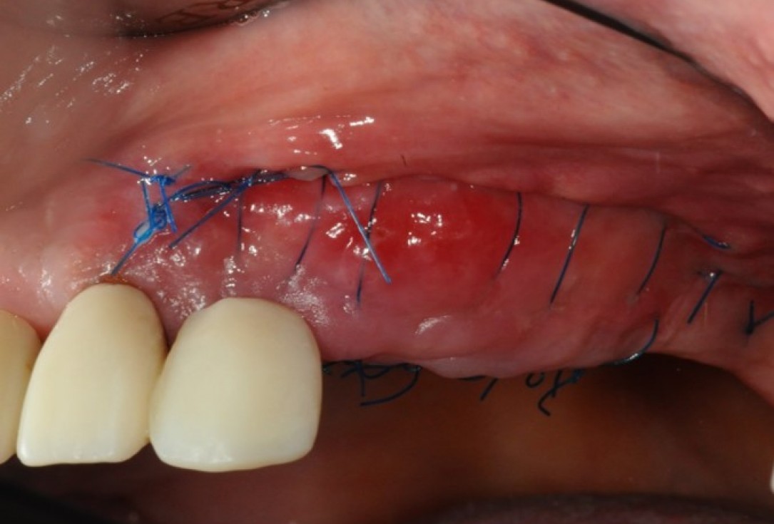 Widening of the peri-implant keratinized mucosa-Horváth