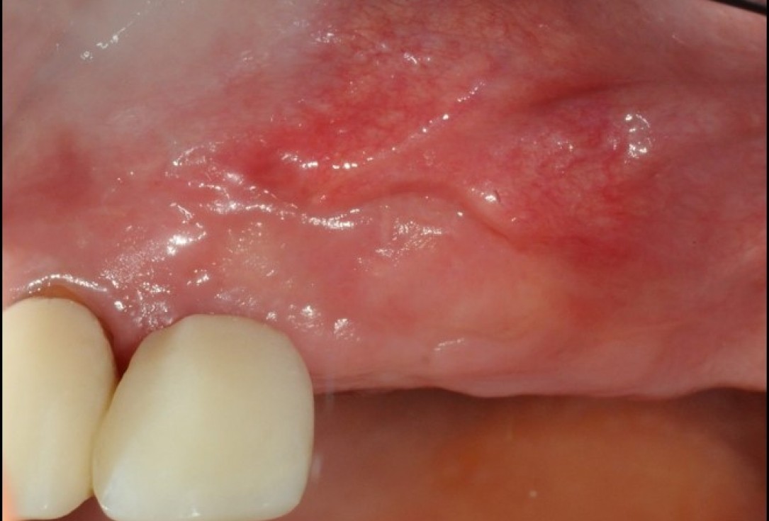 Widening of the peri-implant keratinized mucosa-Horváth