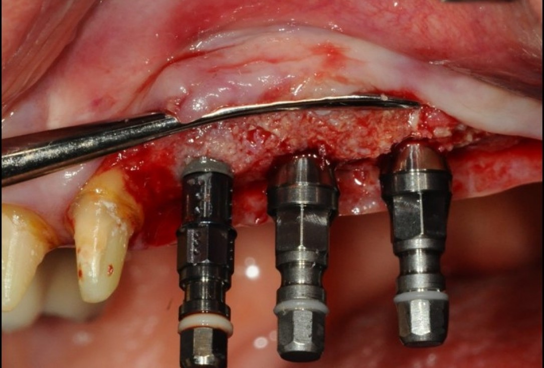 Widening of the peri-implant keratinized mucosa-Horváth
