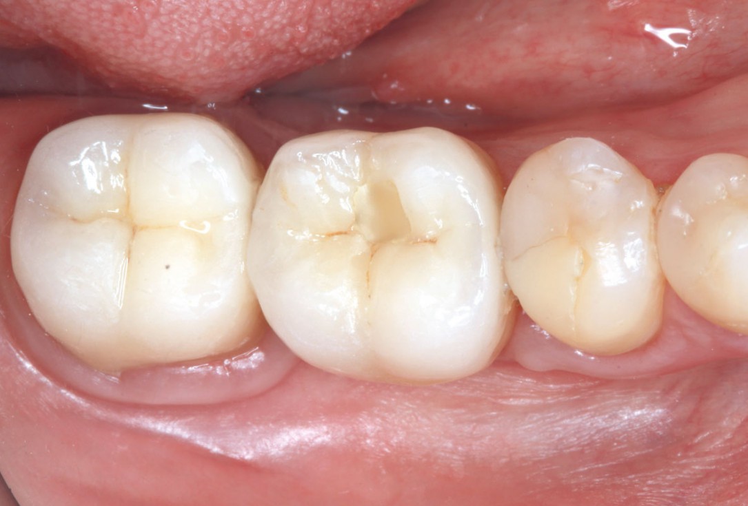 “Poncho technique” with mucoderm® and Straumann® Emdogain® for peri-implant soft tissue augmentation - Dr. A. Puišys, Dr. E. Vindašiūtė-Narbutė, Dr. T. Linkevičius 