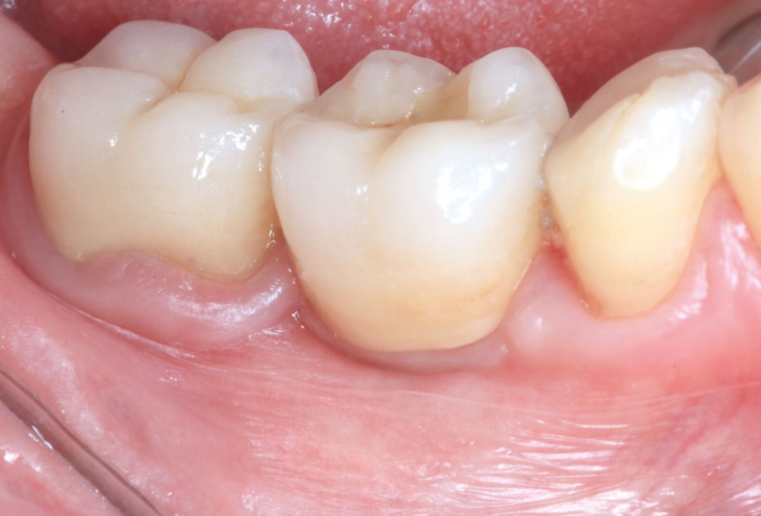 “Poncho technique” with mucoderm® and Straumann® Emdogain® for peri-implant soft tissue augmentation - Dr. A. Puišys, Dr. E. Vindašiūtė-Narbutė, Dr. T. Linkevičius 