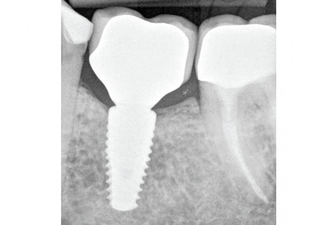“Poncho technique” with mucoderm® and Straumann® Emdogain® for peri-implant soft tissue augmentation - Dr. A. Puišys, Dr. E. Vindašiūtė-Narbutė, Dr. T. Linkevičius 