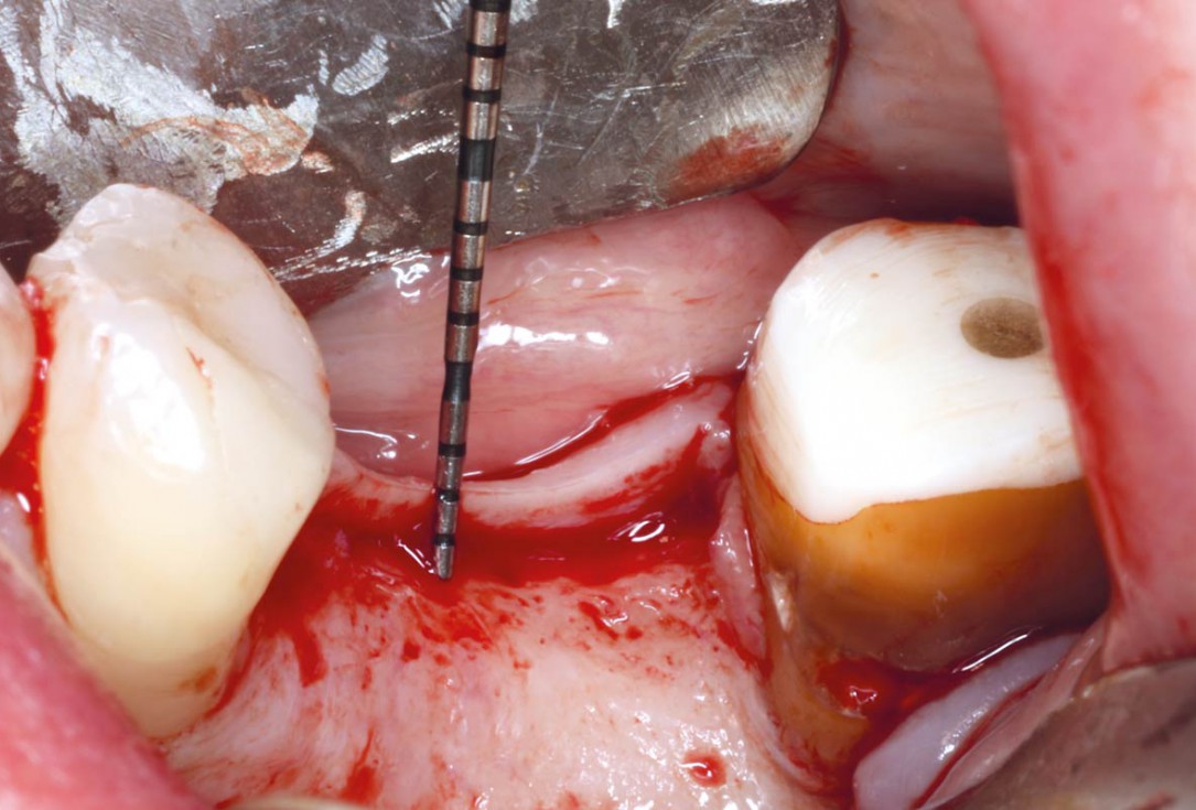 “Poncho technique” with mucoderm® and Straumann® Emdogain® for peri-implant soft tissue augmentation - Dr. A. Puišys, Dr. E. Vindašiūtė-Narbutė, Dr. T. Linkevičius 