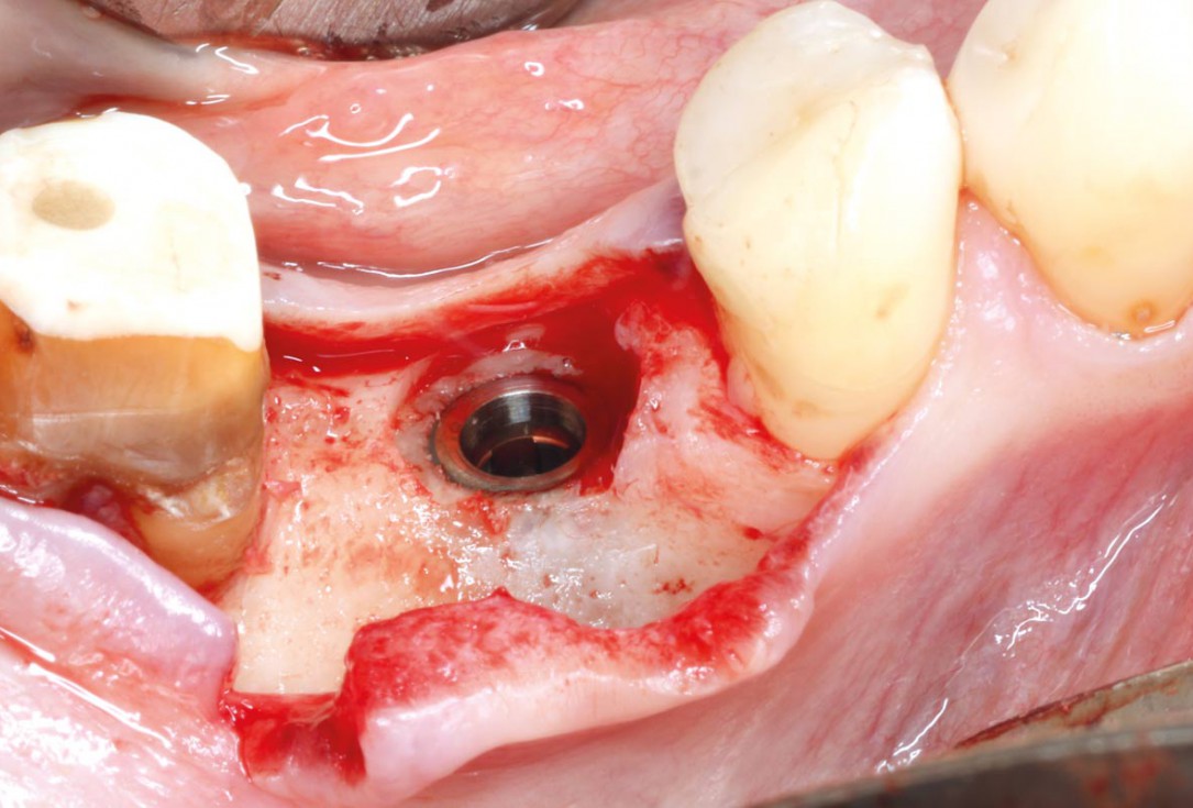 “Poncho technique” with mucoderm® and Straumann® Emdogain® for peri-implant soft tissue augmentation - Dr. A. Puišys, Dr. E. Vindašiūtė-Narbutė, Dr. T. Linkevičius 