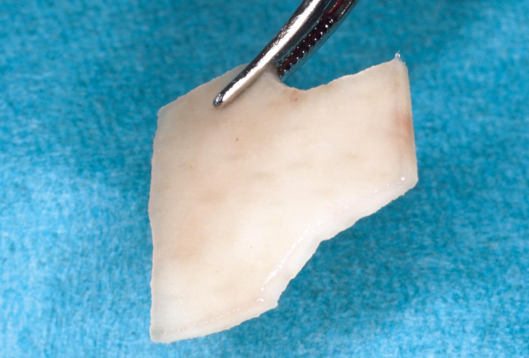 “Poncho technique” with mucoderm® and Straumann® Emdogain® for peri-implant soft tissue augmentation - Dr. A. Puišys, Dr. E. Vindašiūtė-Narbutė, Dr. T. Linkevičius 