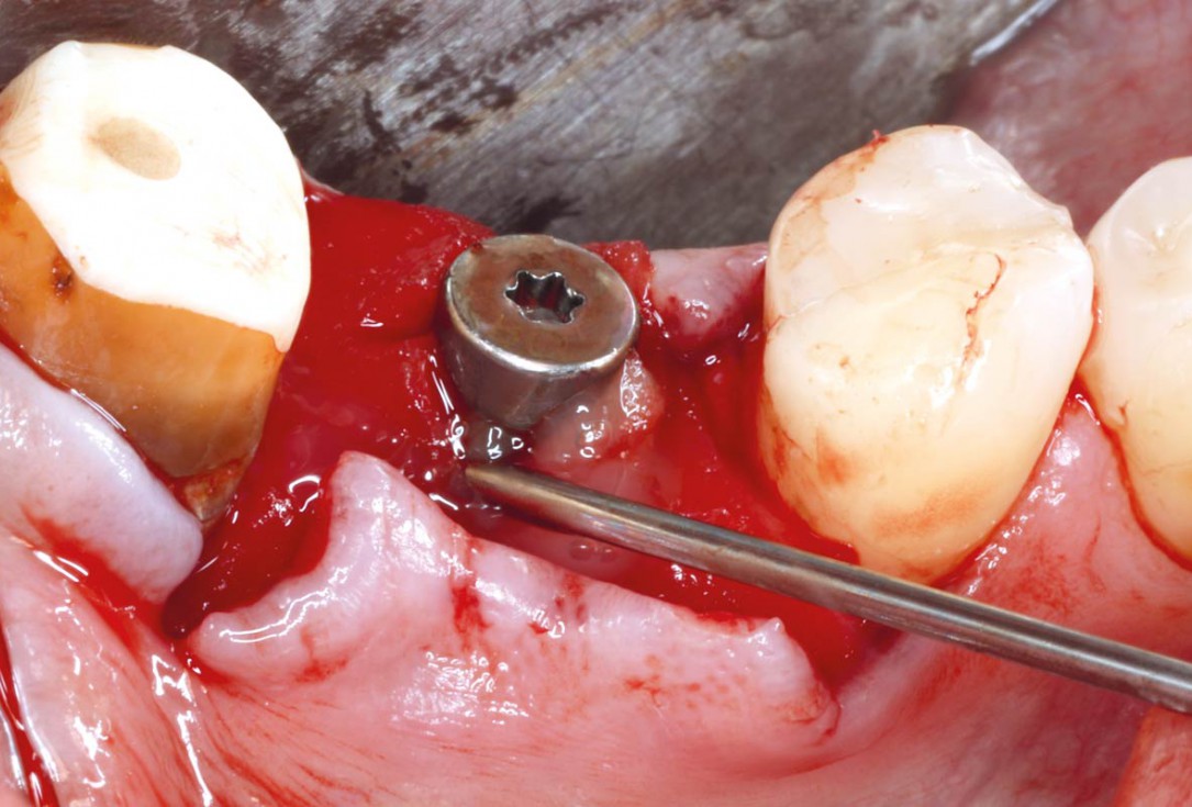 “Poncho technique” with mucoderm® and Straumann® Emdogain® for peri-implant soft tissue augmentation - Dr. A. Puišys, Dr. E. Vindašiūtė-Narbutė, Dr. T. Linkevičius 