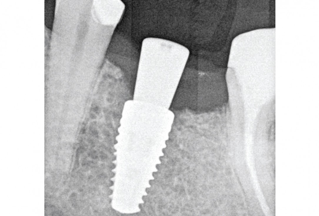 “Poncho technique” with mucoderm® and Straumann® Emdogain® for peri-implant soft tissue augmentation - Dr. A. Puišys, Dr. E. Vindašiūtė-Narbutė, Dr. T. Linkevičius 