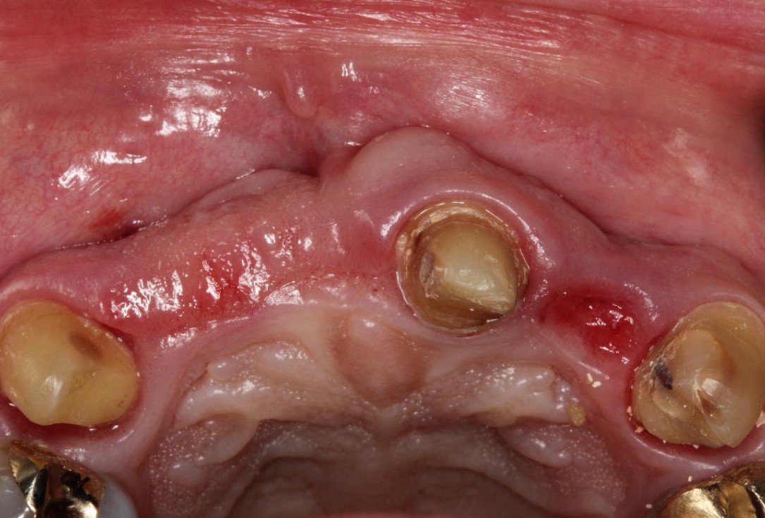 Pre-prosthetic soft tissue augmentation of the ridge contour- Rathe