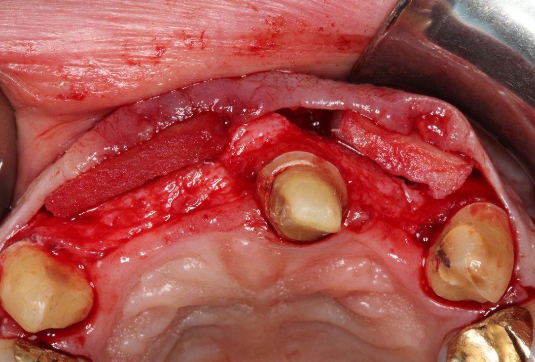 Pre-prosthetic soft tissue augmentation of the ridge contour- Rathe