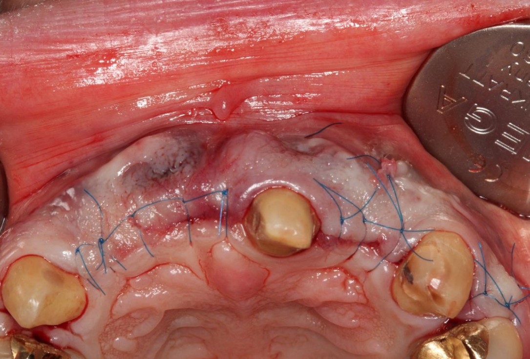 Pre-prosthetic soft tissue augmentation of the ridge contour- Rathe