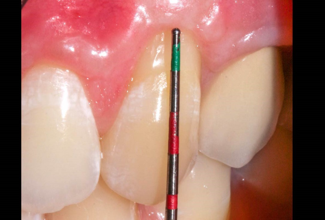 botiss mucoderm® for treatment of single gingival recession - Clinical case