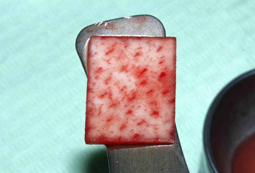 botiss mucoderm® for treatment of single gingival recession - Clinical case