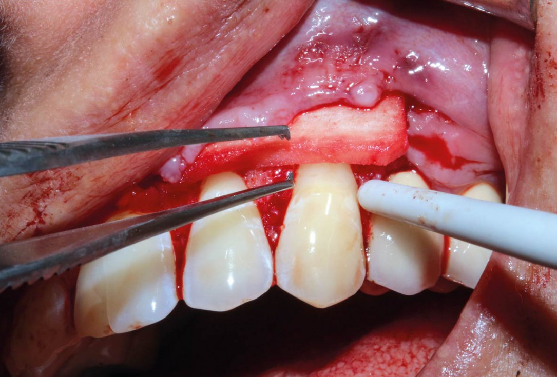 botiss mucoderm® for treatment of single gingival recession - Clinical case