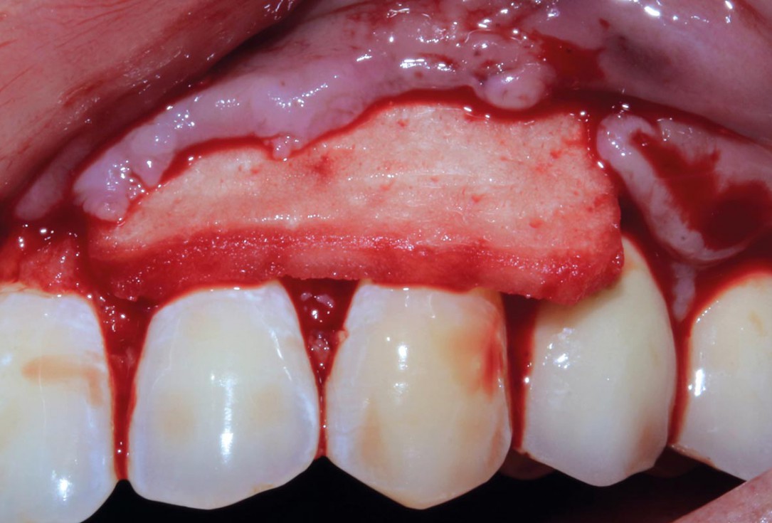 botiss mucoderm® for treatment of single gingival recession - Clinical case