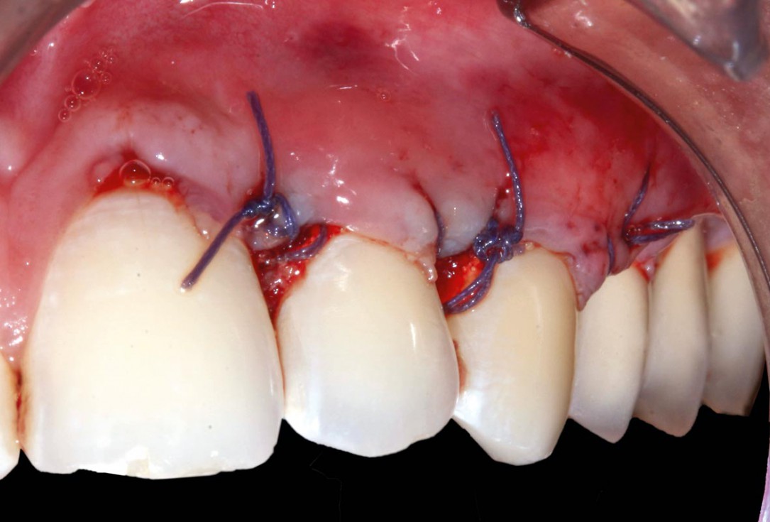 botiss mucoderm® for treatment of single gingival recession - Clinical case