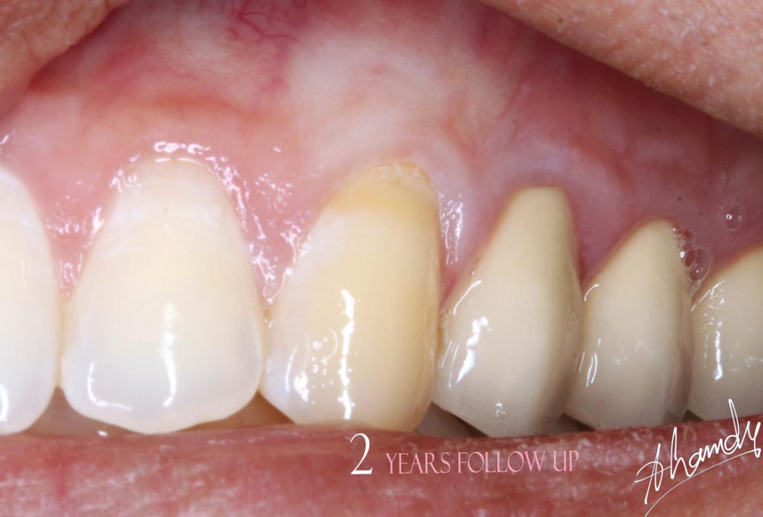 botiss mucoderm® for treatment of single gingival recession - Clinical case