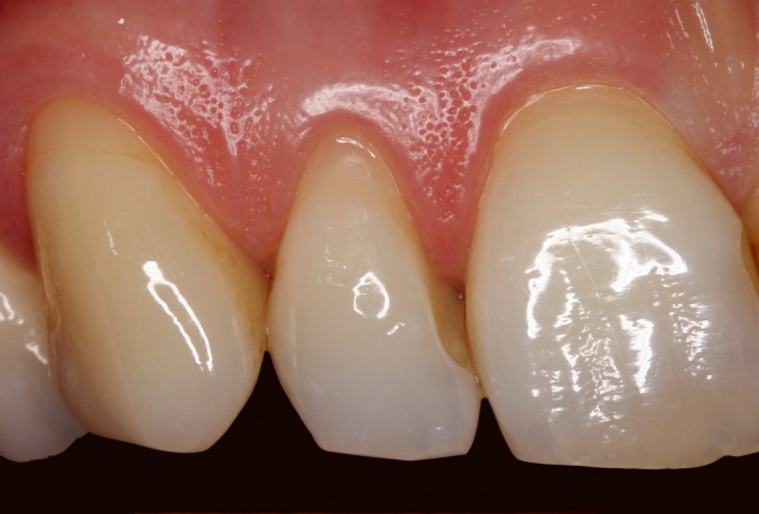 01/07 botiss mucoderm® for coverage of multiple recessions - clinical case by Dr. S. Stavar