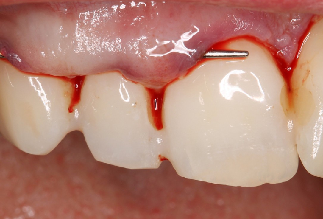 02/07 botiss mucoderm® for coverage of multiple recessions - clinical case by Dr. S. Stavar