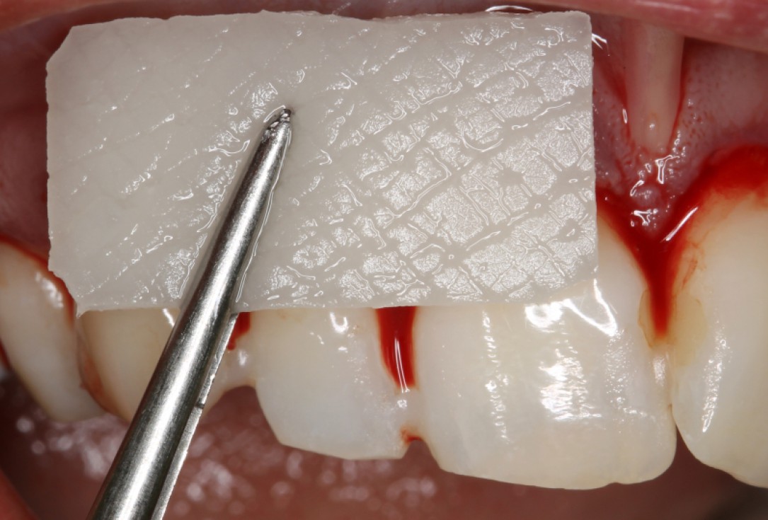 03/07 botiss mucoderm® for coverage of multiple recessions - clinical case by Dr. S. Stavar